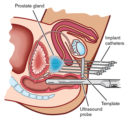 prostatitis laser surgery